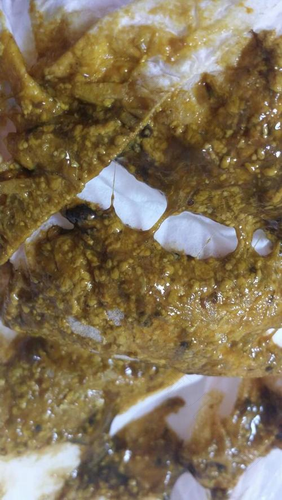 大便水泥色是怎么回事 大便水泥色是怎么回事