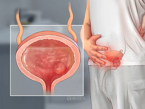 女性尿频尿急尿痛的原因引起的