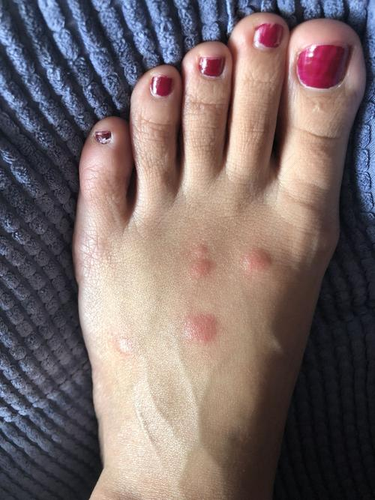 身上湿毒痒怎么办 身上湿毒痒怎么办