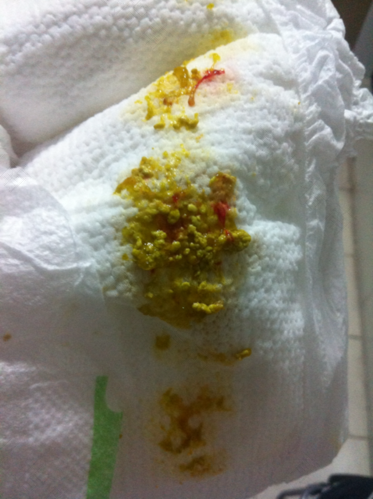 肠胃痛便血是怎么回事 肠胃痛便血是怎么回事