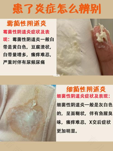 霉菌性阴炎怎么治疗好 霉菌性阴炎怎么治疗好