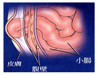 目前治疗疝气最好的方法 目前治疗疝气最好的方法