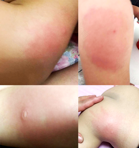 婴儿打完疫苗有硬块怎么办 婴儿打完疫苗有硬块怎么办