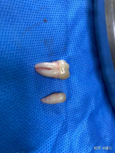 长智齿疼几天能好 长智齿疼几天能好