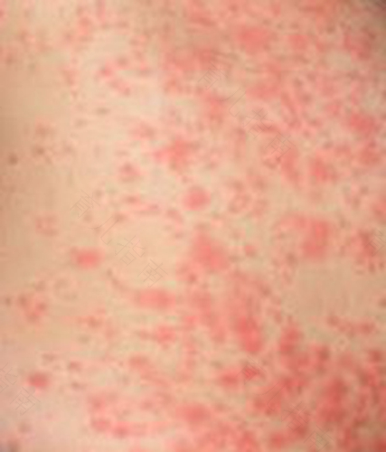 皮炎和湿疹怎么治疗 皮炎和湿疹怎么治疗