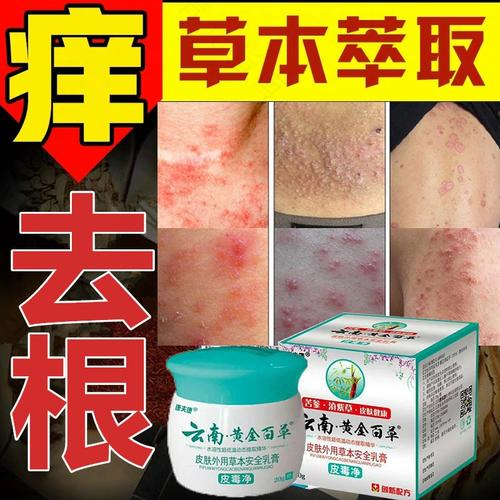 皮肤湿疹怎么治疗?