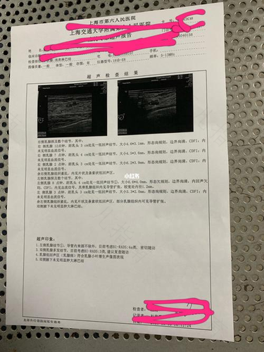 双侧乳腺囊病灶是什么 双侧乳腺囊病灶是什么