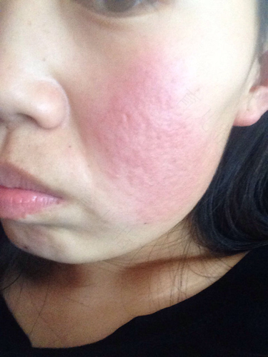 过敏一般怎么治疗 过敏一般怎么治疗