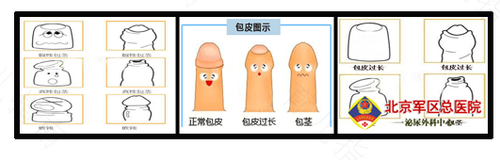 包茎有几种手术方法 包茎有几种手术方法