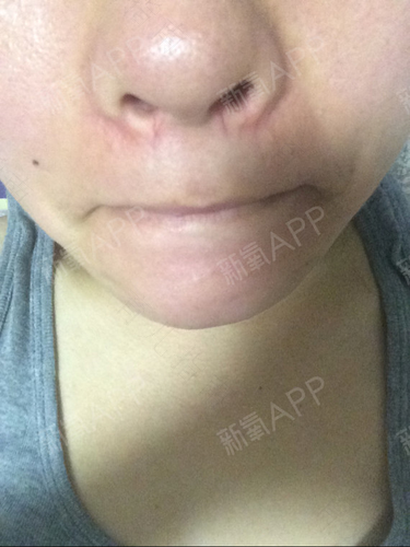 鼻子里总有红血丝怎么办 鼻子里总有红血丝怎么办