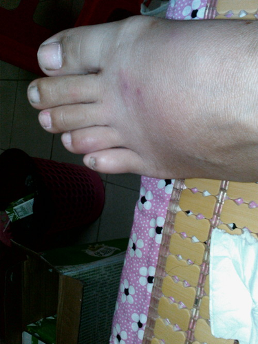 高血压脚肿是怎么回事 高血压脚肿是怎么回事