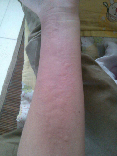 荨麻疹怎么治疗呢? 荨麻疹怎么治疗呢?