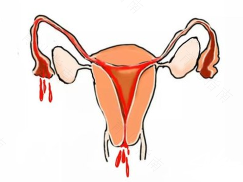 人流后感染盆腔炎怎么办 人流后感染盆腔炎怎么办