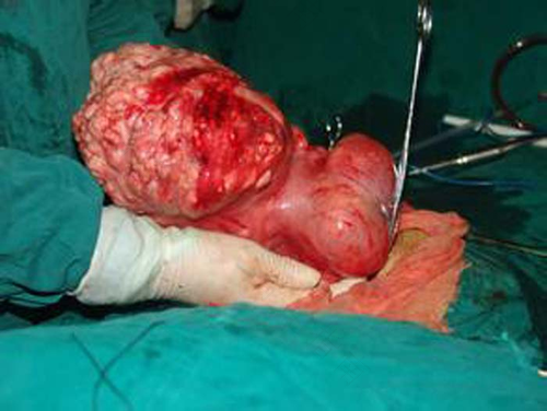 切除子宫会不会老的快呢 切除子宫会不会老的快呢