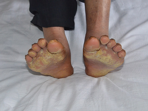 脚掌发烧难受怎么回事 脚掌发烧难受怎么回事