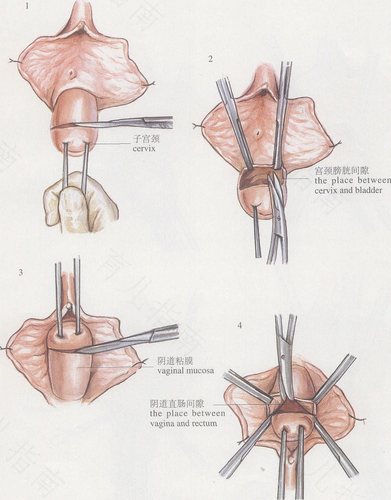 宫颈能切除吗? 宫颈能切除吗?