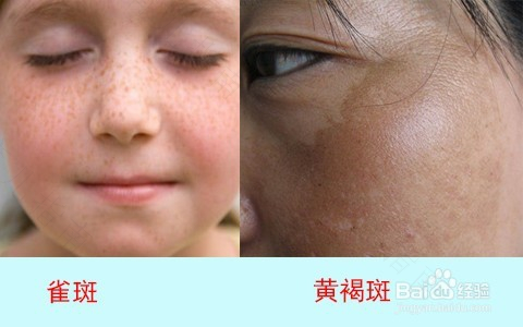 肝火旺容易长斑吗? 肝火旺容易长斑吗?