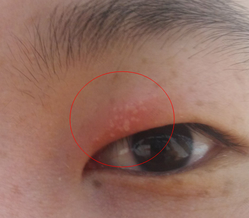 一到春天眼角痒是怎么回事 一到春天眼角痒是怎么回事