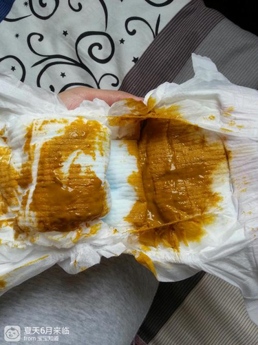 大便长期稀泥状而且粘 大便长期稀泥状而且粘