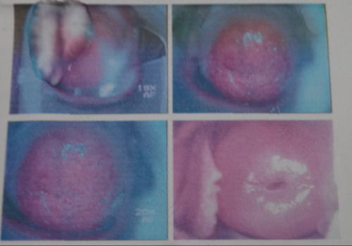 22岁宫颈糜烂怎么办呢 22岁宫颈糜烂怎么办呢