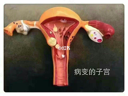 附件炎盆腔炎怎么治 附件炎盆腔炎怎么治