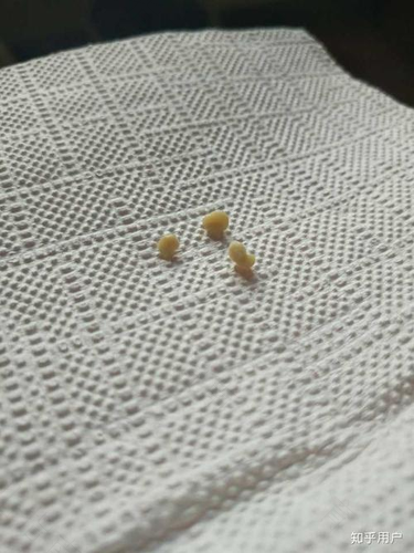 得了扁桃体结石怎么办喝茶 得了扁桃体结石怎么办喝茶