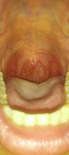 嗓子干怎么回事儿 嗓子干怎么回事儿