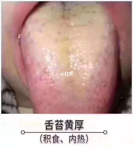 孩子舌苔黄咳嗽是怎么回事 孩子舌苔黄咳嗽是怎么回事