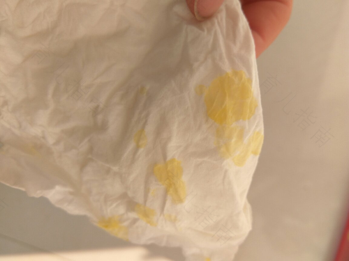 鼻涕黄绿色是怎么回事?