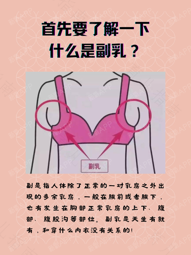 长副乳是怎么回事 长副乳是怎么回事
