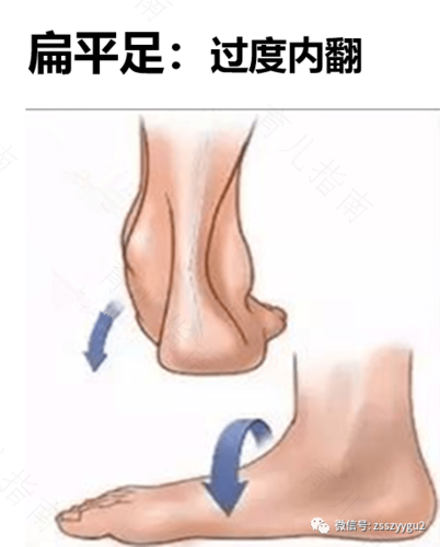 扁平足是什么原因引起的 扁平足是什么原因引起的