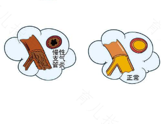 支气管炎的症状表现在哪些方面 支气管炎的症状表现在哪些方面