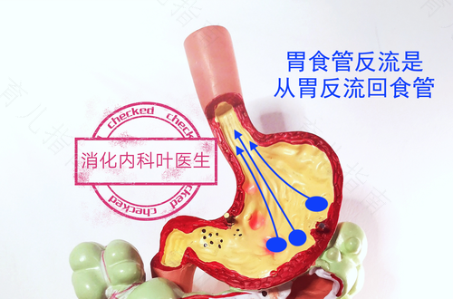 为什么胃液反流是怎么引起的