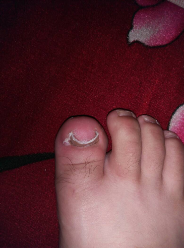 小孩脚趾甲翘着长怎么回事 小孩脚趾甲翘着长怎么回事