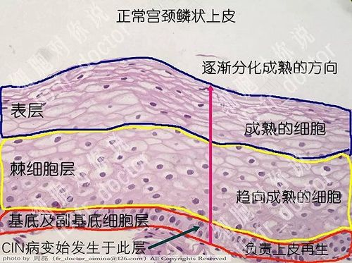 宫颈cin是什么意思