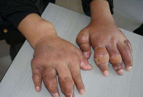 如何减轻痛风的疼痛