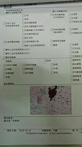 宫颈tct检查怎么检查