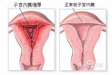 为什么会子宫内膜粘连