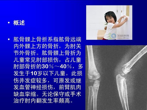 肱骨骨折会留下后遗症吗 肱骨骨折会留下后遗症吗