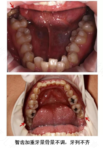 智齿牙髓炎可以直接拔牙吗 智齿牙髓炎可以直接拔牙吗