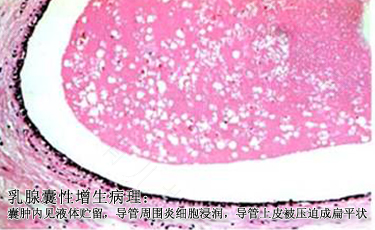 如何治疗乳腺囊性增生病 如何治疗乳腺囊性增生病