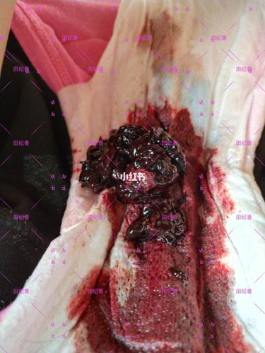 子宫壁厚需要做手术吗