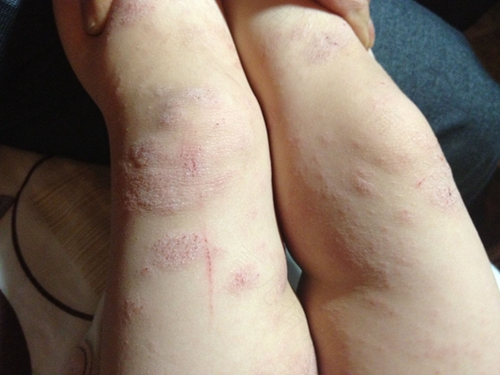 皮肤真菌感染传染吗 皮肤真菌感染传染吗