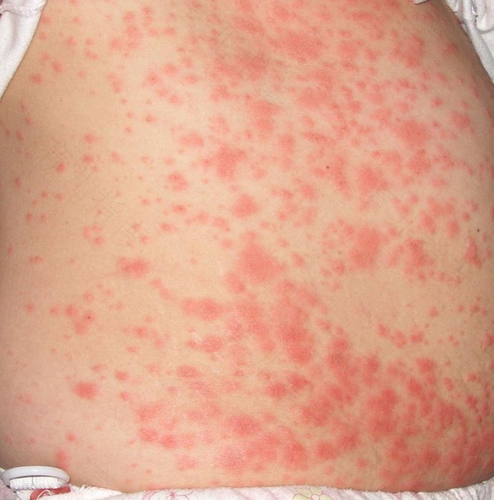 过敏性皮炎抓破皮怎么办 过敏性皮炎抓破皮怎么办