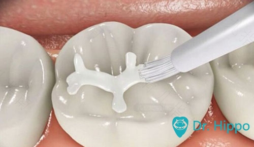 六龄牙蛀牙了怎么办 六龄牙蛀牙了怎么办