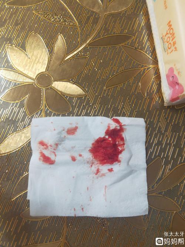 宝宝鼻子老是流血怎么回事 宝宝鼻子老是流血怎么回事