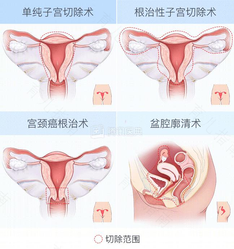 宫颈可以切除吗,有影响吗 宫颈可以切除吗,有影响吗