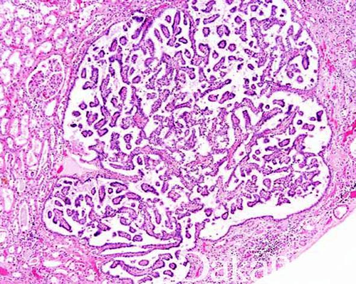 肾乳头周围包有哪些 肾乳头周围包有哪些