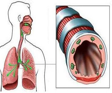 咳嗽变异性哮喘能治愈吗 咳嗽变异性哮喘能治愈吗
