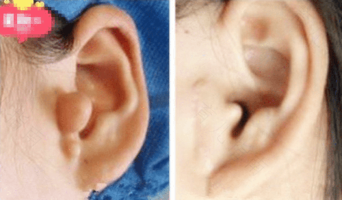 什么原因胎儿会长附耳 什么原因胎儿会长附耳